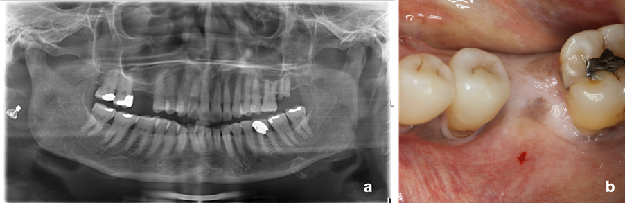 Fig. 1: A 63-year-old woman presented with a hopeless lower left first molar (a). The tooth was atraumatically extracted, photo b shows the healed edentulous area 3 months post-extraction