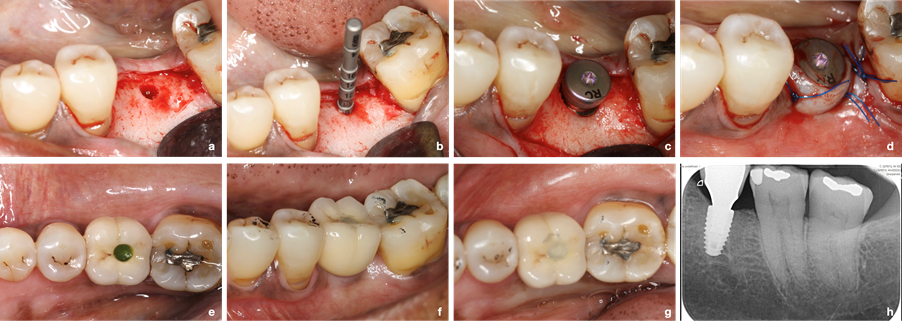 Fig. 2: An implant with a hydrophilic micro-rough surface was placed in the edentulous site of the lower left first molar (a, b, c, d). Loading was performed 8 weeks after unsubmerged healing (e). At 2 years post-loading, the implant showed a pleasant aesthetic outcome and stable radiographic peri-implant bone levels (f, g, h) [Surgery performed by Dr. Nikos Mardas]