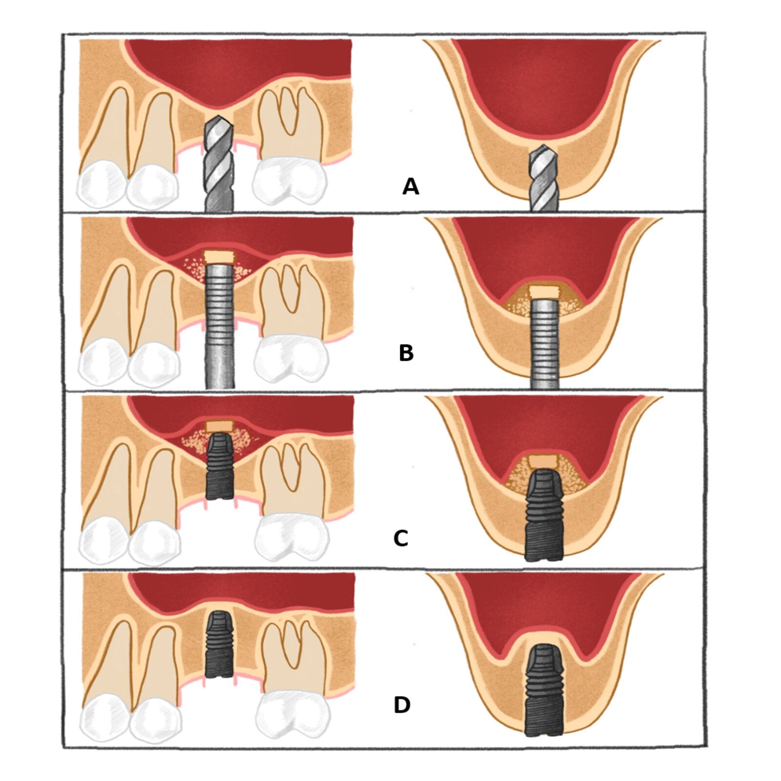 Sinus floor elevation in implant dentistry Part 2 ITI Blog