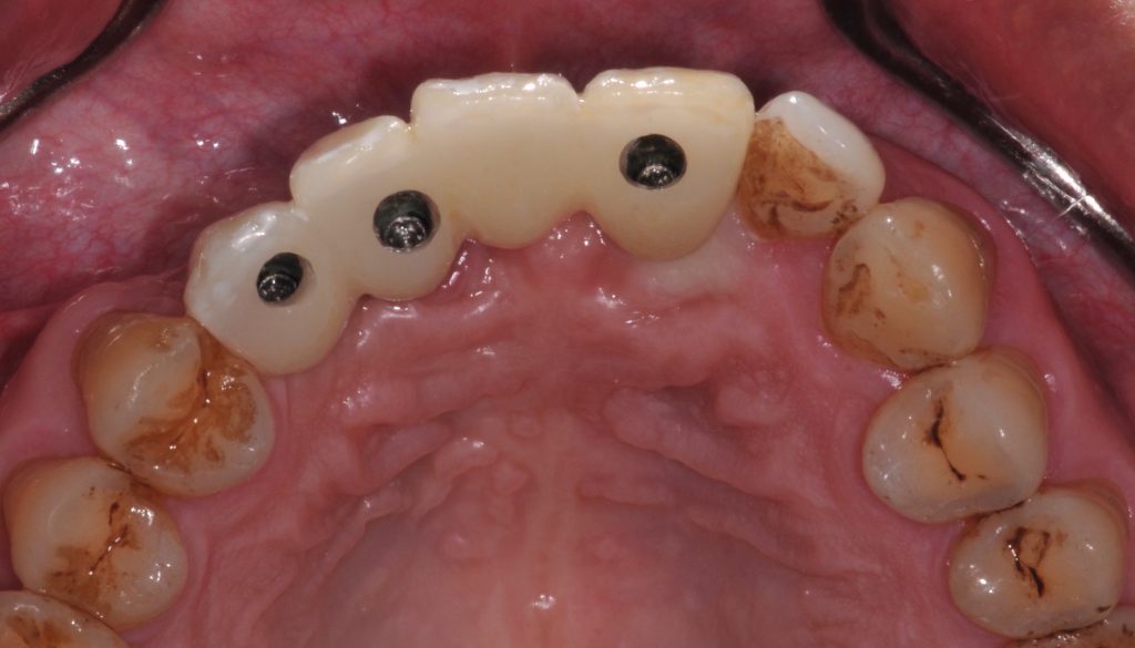 Fig. 11: Occlusal view of the screw access channel using an angled screw channel solution for the same case. Note that the position of the screw access channels has been shifted more palatally and away from the connector areas