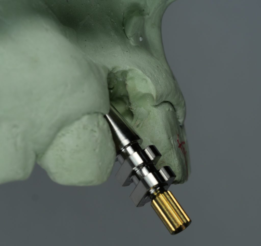 Fig. 12: Placement of implant angled facially with screw access hole emerging buccal to the incisal edge