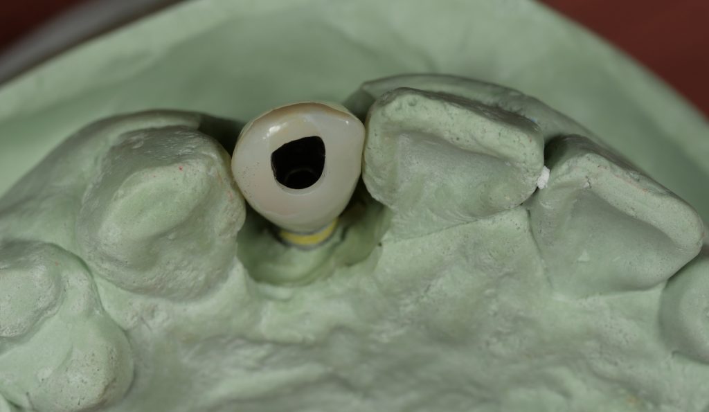 Fig. 14: Prosthesis fabricated with angulated screw system. Occlusal view of the screw access channel with the position of the screw access channel corrected to be more palatal to the incisal edge