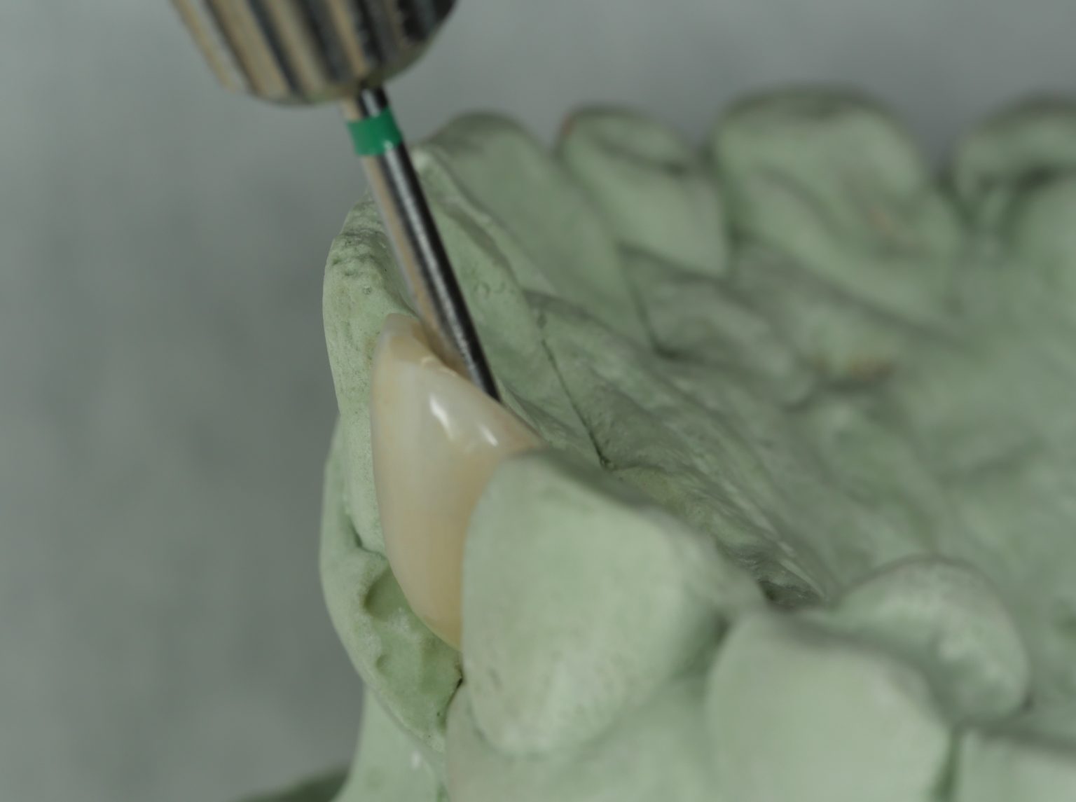 Fig. 15: Lateral view of the prosthesis showing the angulated screw system screwdriver in the access hole. The screwdriver can engage the screw through the access hole on the palatal surface of the prosthesis after the screw channel angulation has been changed