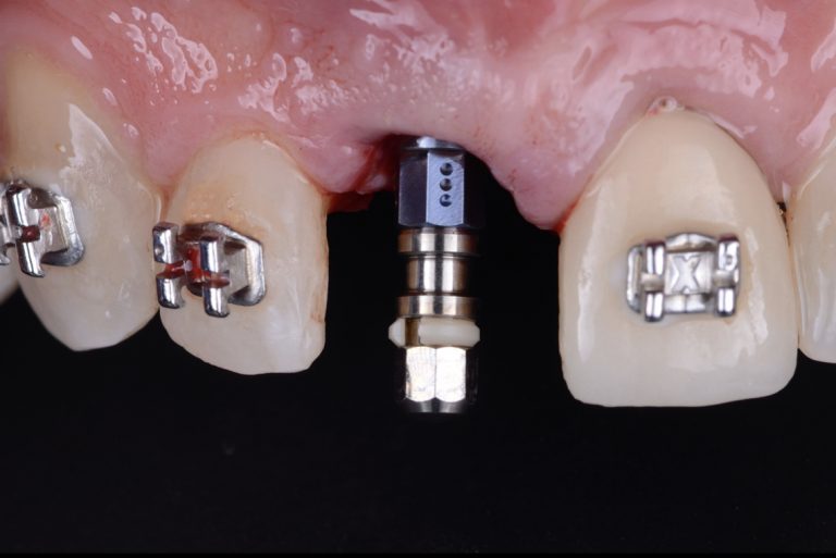 Guidelines For Ridge Preservation: When And How - ITI Blog