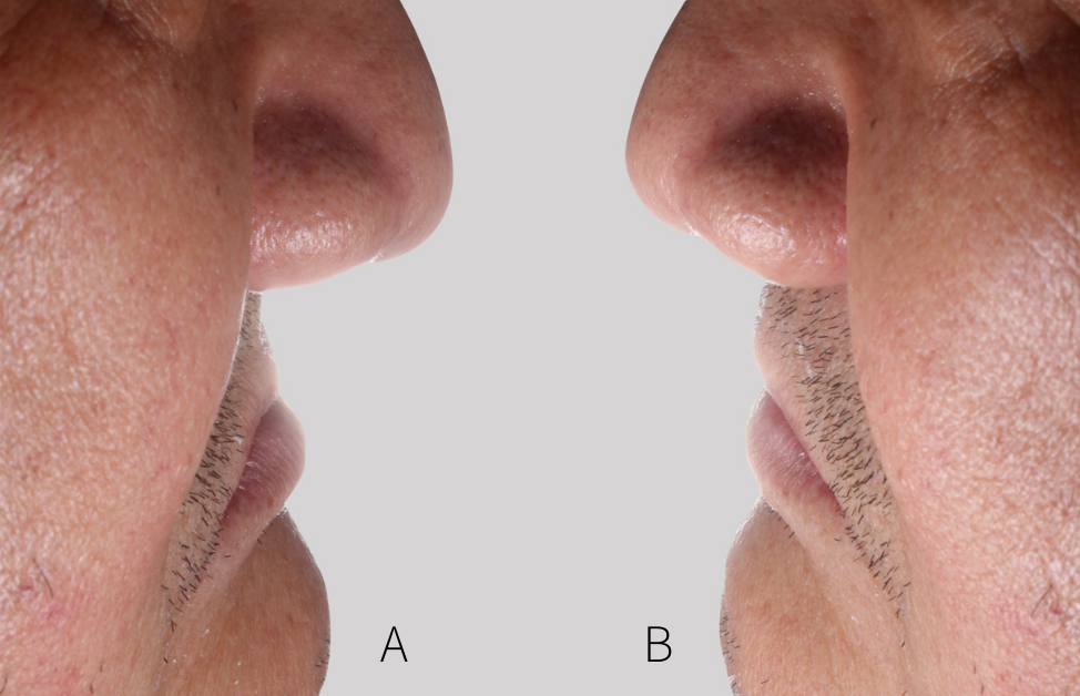 Fig. 4: Dynamic information can be easily shown with trial dentures in the mouth. A: Initial status. B: Patient wearing trial dentures