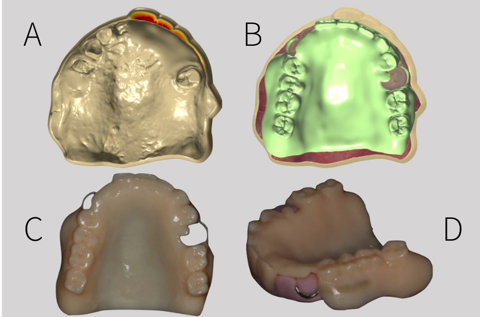 Fig. 7: CAD of the immediate denture and surveyed temporary crown. A: Trim the hopeless teeth and do virtual alveoplasty; B: CAD of immediate denture and shell of maxillary left second premolar surveyed temporary crown; C: Printed interim denture. D: Use silicon key to position wrought wire clasp and assemble wrought wire clasp with the interim denture