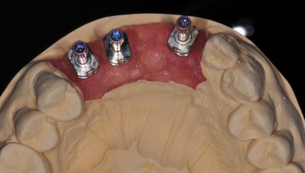 Fig. 9: Buccal angulation of anterior implants as shown from the occlusal view