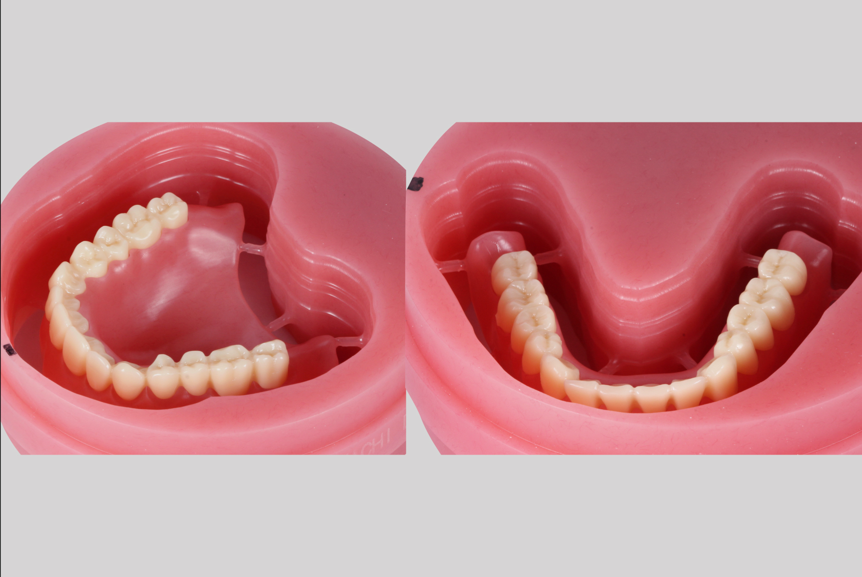 Fig. 5: Bond milled teeth on milled denture bases. A: maxillary denture; B: mandibular denture