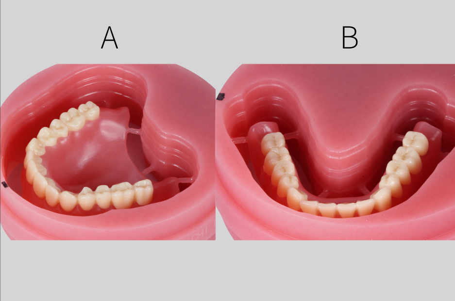 Fig. 5: Bond milled teeth on milled denture bases. A: maxillary denture; B: mandibular denture