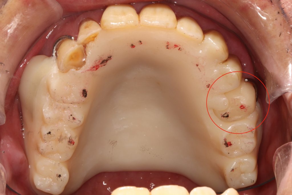 Fig. 8: Deliver immediate maxillary denture and the maxillary left second premolar surveyed temporary crown