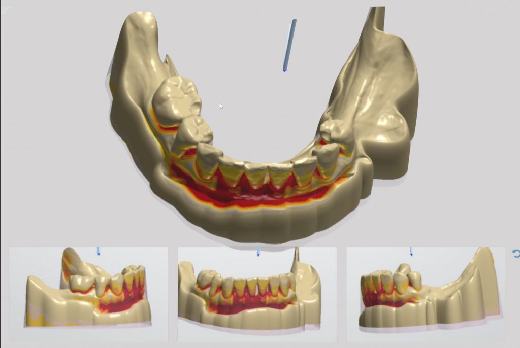 Fig. 9: View of virtual block-out. The block-out can be seen from different angles

