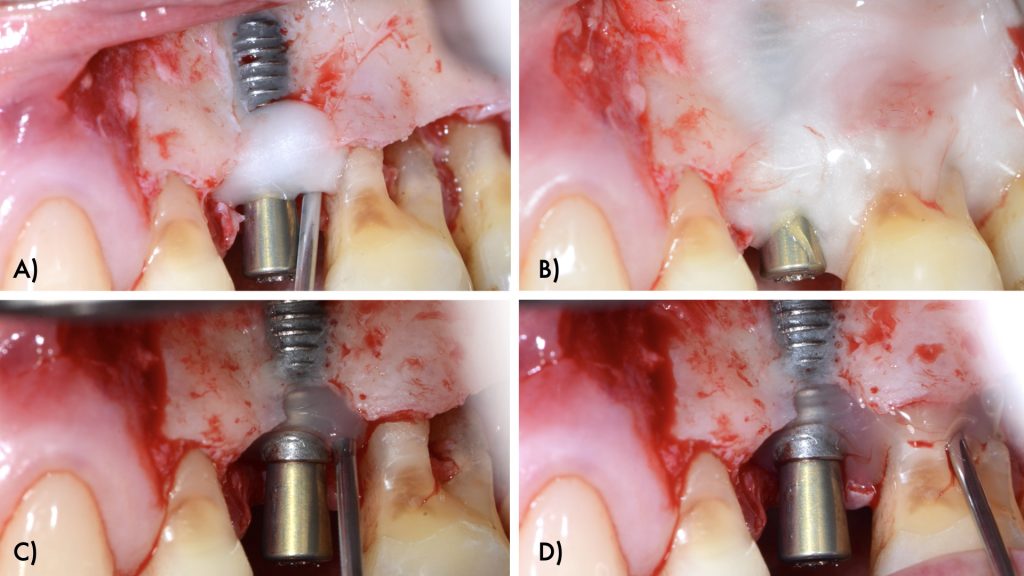 A: Application of EDTA on the implant surface; B: Application of EDTA on the root surface; C: Application of enamel matrix proteins on the implant surface; D: Application of enamel matrix proteins on the root surface