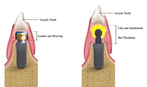 Fig. 1: Prosthetic space needed for bar and locator attachments