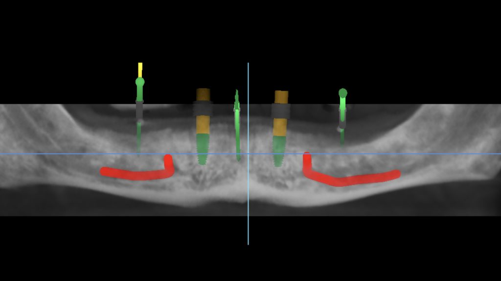 Fig. 5: Planned implant positions in a panoramic view. Implants were placed at the canine position and as parallel as possible to each other