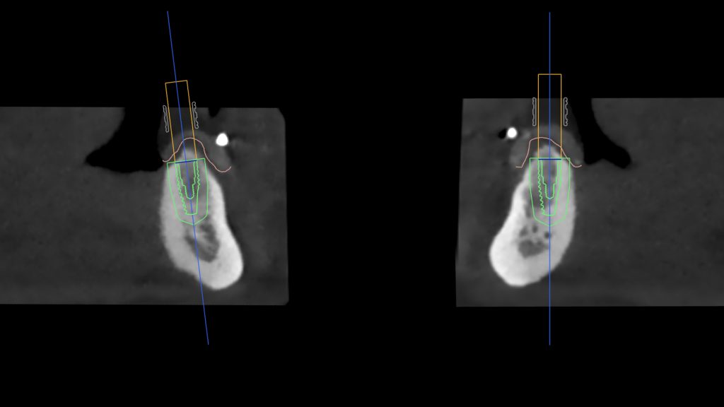Fig. 7: Implant planning in a sagittal perspective of the CBCT