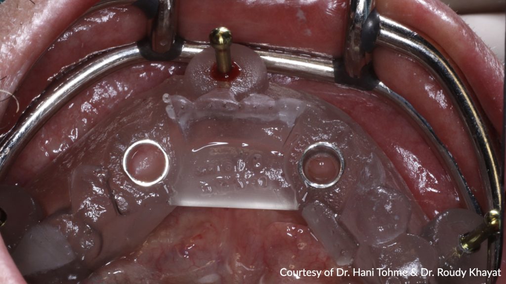 Fig. 9: A surgical guide was fixed on the mandibular arch with the aid of fixation pins