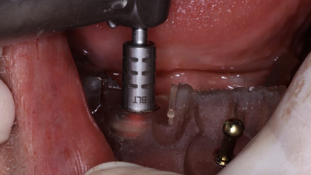 Fig. 13: Implant placement with the aid of the surgical guide