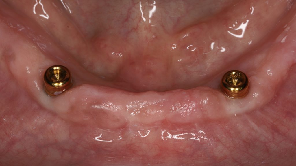 Fig. 18: Locators tightened over the implants to receive a mandibular IOD