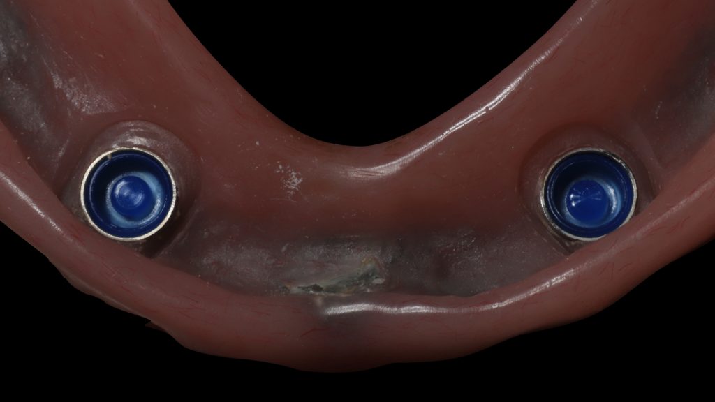 Fig. 21: Blue inserts were fixed to the female part of the locator in the denture