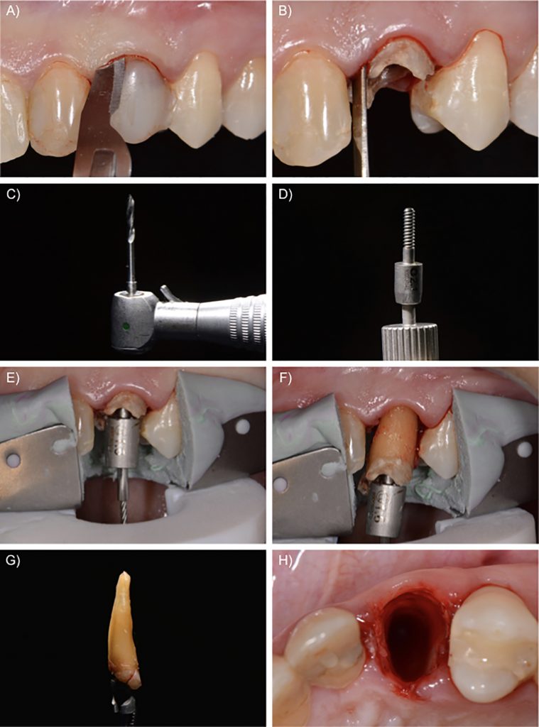 Fig. 1: Minimally invasive tooth extraction. A) Intra-sulcular incision without papilla involvement; B) Tooth luxation with a periotome; C) Drill used to prepare the root canal for vertical extraction; D) Detail of the extraction system; E) Vertical extraction system ready for activation; F) Tooth being removed vertically; G) Tooth after removal; H) Fresh alveolar socket with preserved bone walls and soft tissues