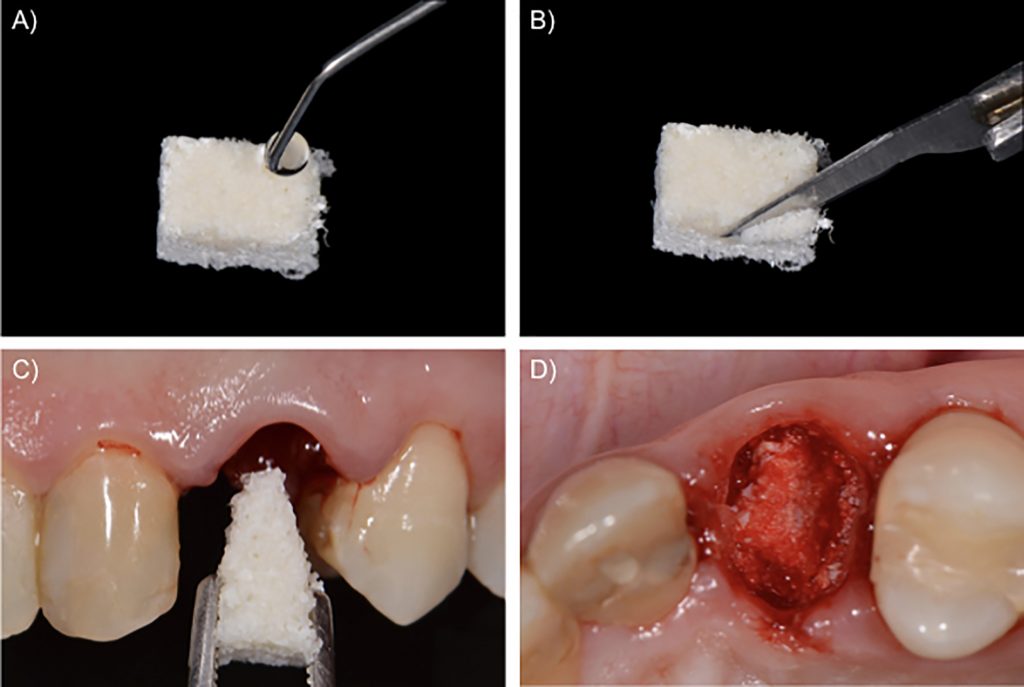 Fig. 2: Alveolar socket filling. A) Slowly resorbing biomaterial (demineralized bovine bone mineral with 10% collagen) moistened with saline solution; B) Slicing biomaterial with a sharp blade; C) Filling the socket with the biomaterial; D) Alveolar socket filled with biomaterial up to bone crest level