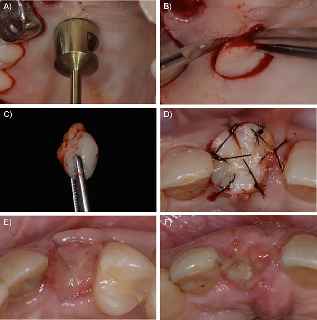 Fig. 3: Socket sealing with a free autogenous graft from the palate. A) Incision on the donor site with an 8-mm punch; B) After holding the soft tissue with tweezers, a scalpel is used to remove the graft; C) Soft tissue graft after removal; D) Soft tissue graft sutured on the receptor bed; E) One possible scenario is the soft tissue healing with incorporation of the graft (2-week follow-up); F) Another possible situation is the necrosis of the graft, which may not impair the results of the procedure if granulation tissue has formed under the graft to maintain the biomaterial inside the socket