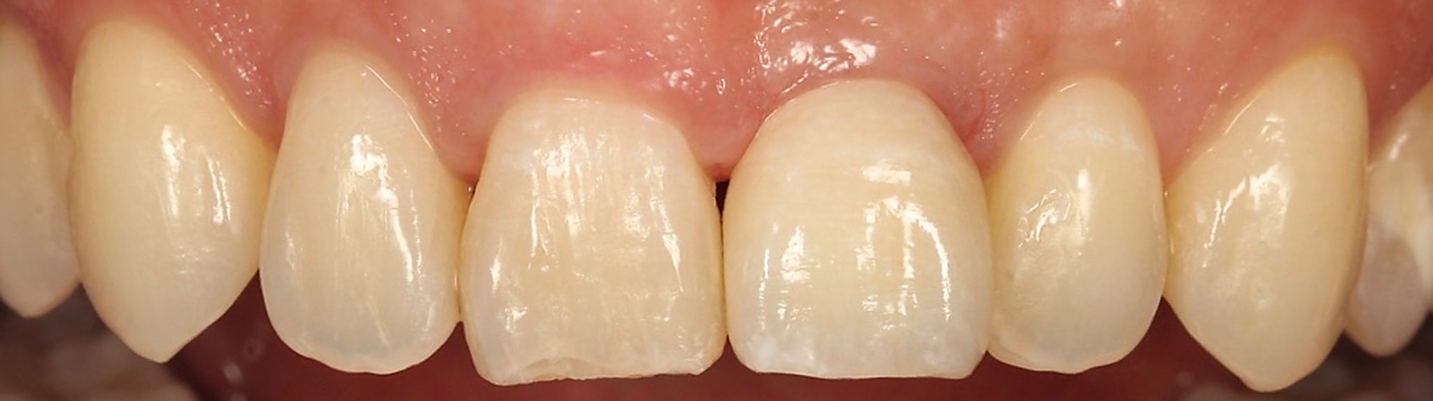 Interproximal papilla for single-tooth implant restorations – risk factors