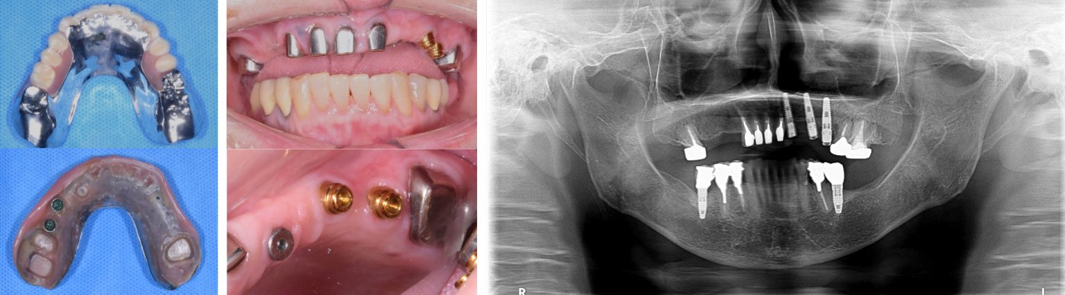 After rehabilitation, the patient was able to take care of her teeth independently