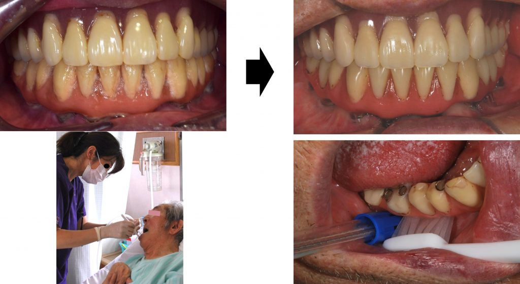 The plaque control of the bone-anchored bridge by the caregiver was poor and required professional hygiene management