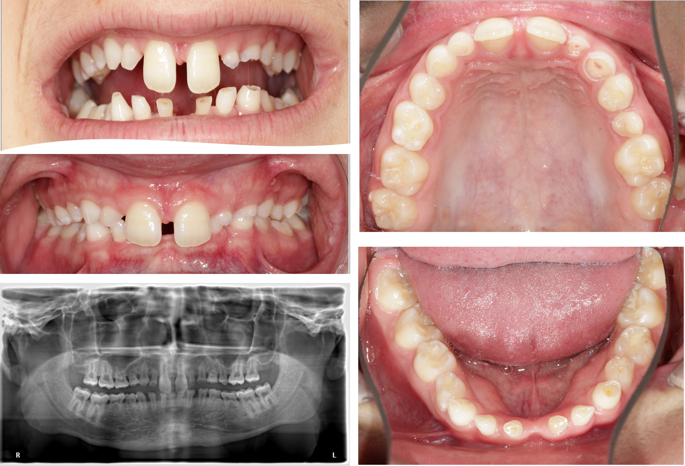 Ask a Dentist: How Long Do Clear Braces Last? - GK Dental PC