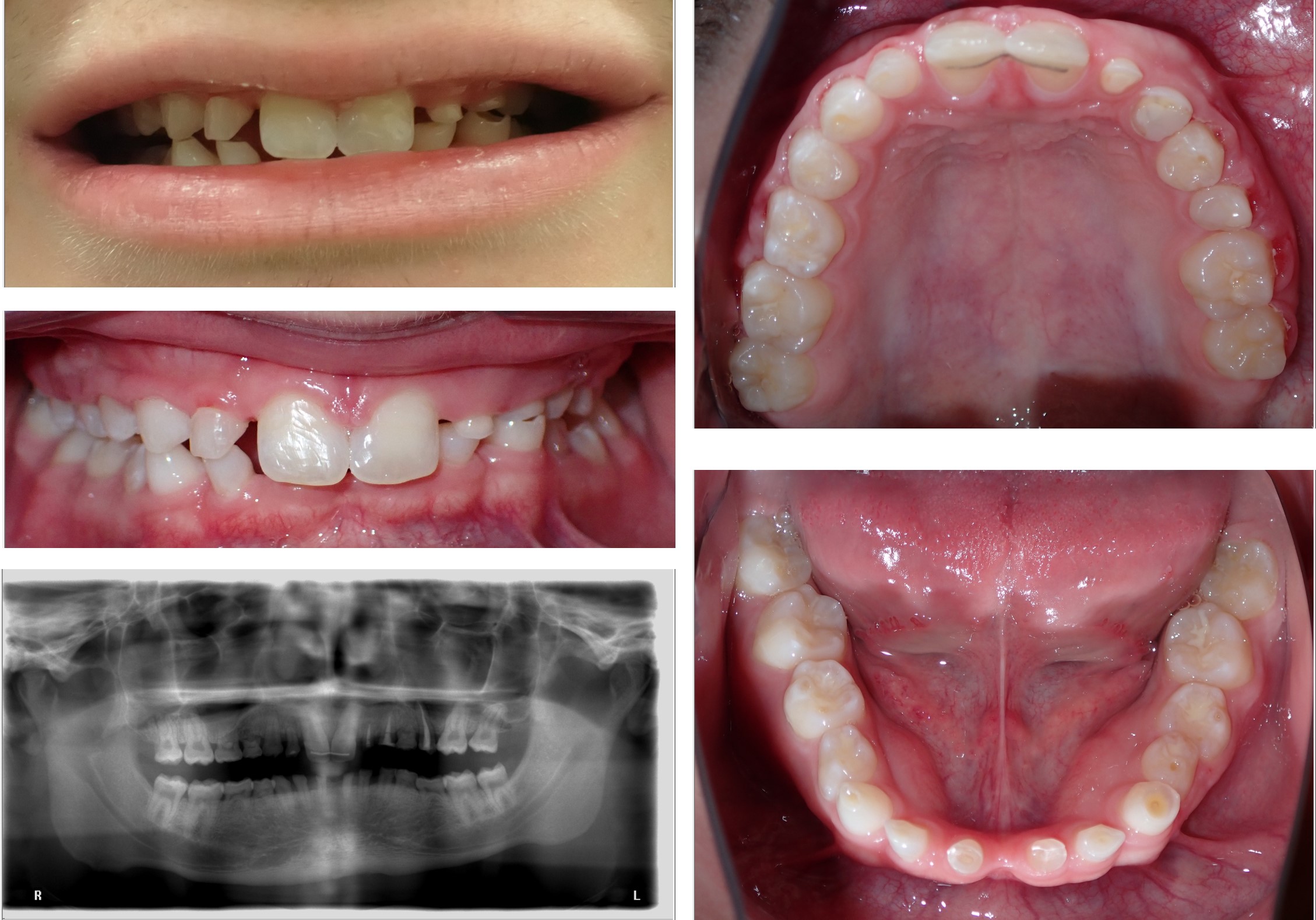 Ask a Dentist: How Long Do Clear Braces Last? - GK Dental PC