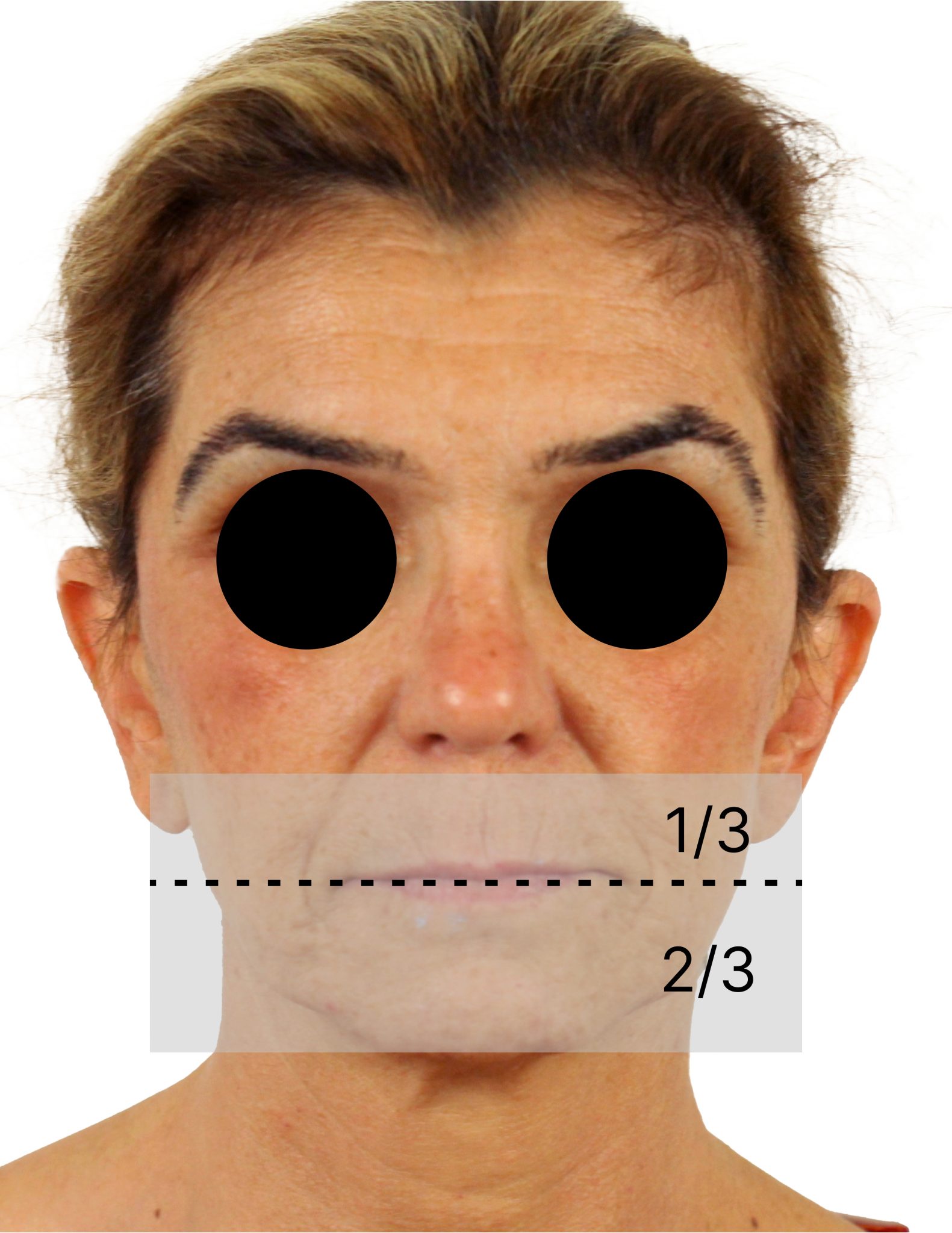 The esthetic parameters in complete full arch rehabilitation - ITI Blog