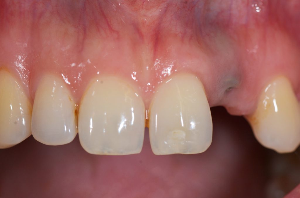 Pre-operative view: ridge volume deficiency with buccal concavity resulting in a “dark shadow“ in the area of #22