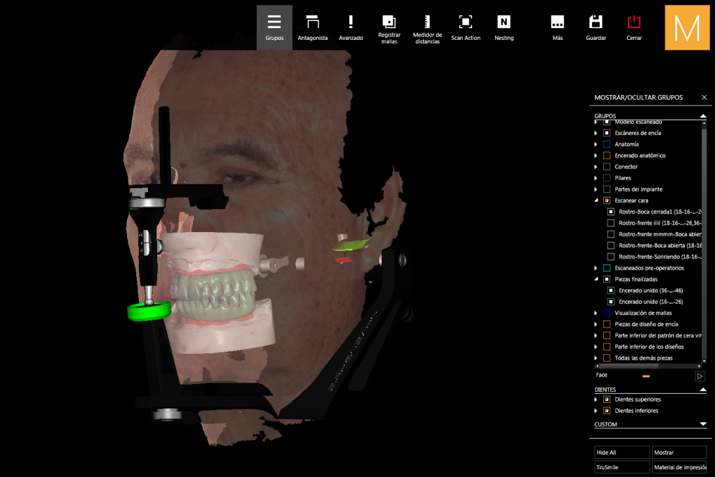 Bi-maxillary fixed implant-supported reconstruction designed in the virtual patient