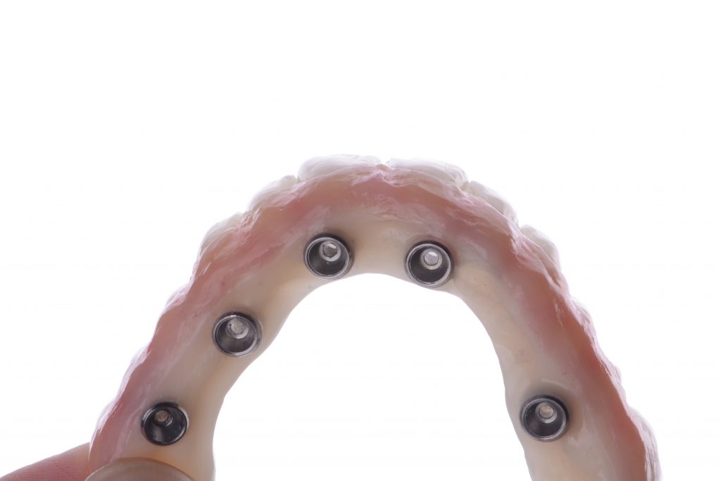 Maxillary PMMA prototype. The intaglio surface (flat or convex) must be designed for proper hygiene