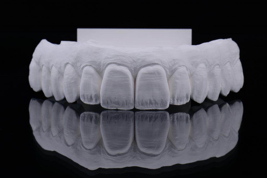 Cutback limited to nonfunctional areas, reducing the risk of chipping of veneering porcelain and improving esthetics of anterior teethFig. 17: Cutback limited to nonfunctional areas, reducing the risk of chipping of veneering porcelain and improving esthetics of anterior teeth