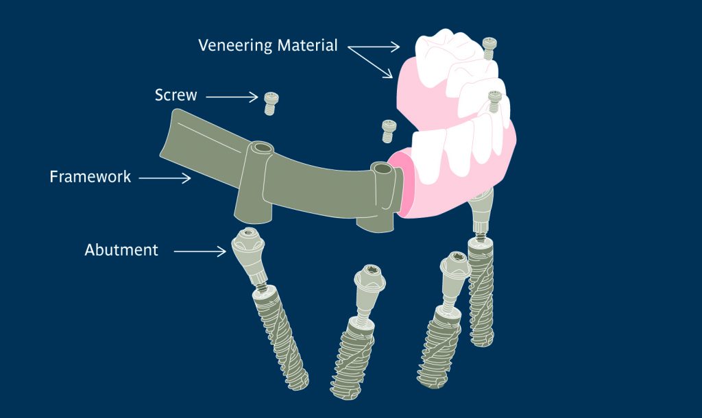 Prosthetic components required for a metal-acrylic full-arch screw-retained implant restoration
