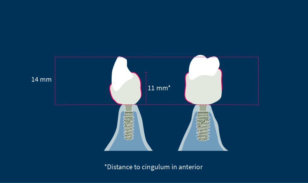 Minimum inter-occlusal space required for a monolithic zirconia IFCDP. This measurement should consider the soft tissue thickness of the edentulous ridge