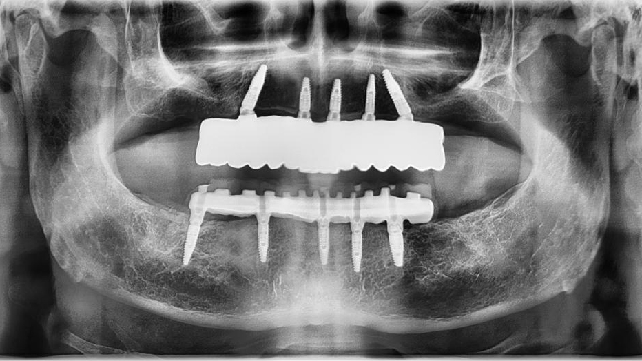 Post-operative panoramic radiograph after 2 years of service showing the implant distribution tilting distal implants avoiding the maxillary sinuses and reducing distal cantilevers to the size of one maxillary molar