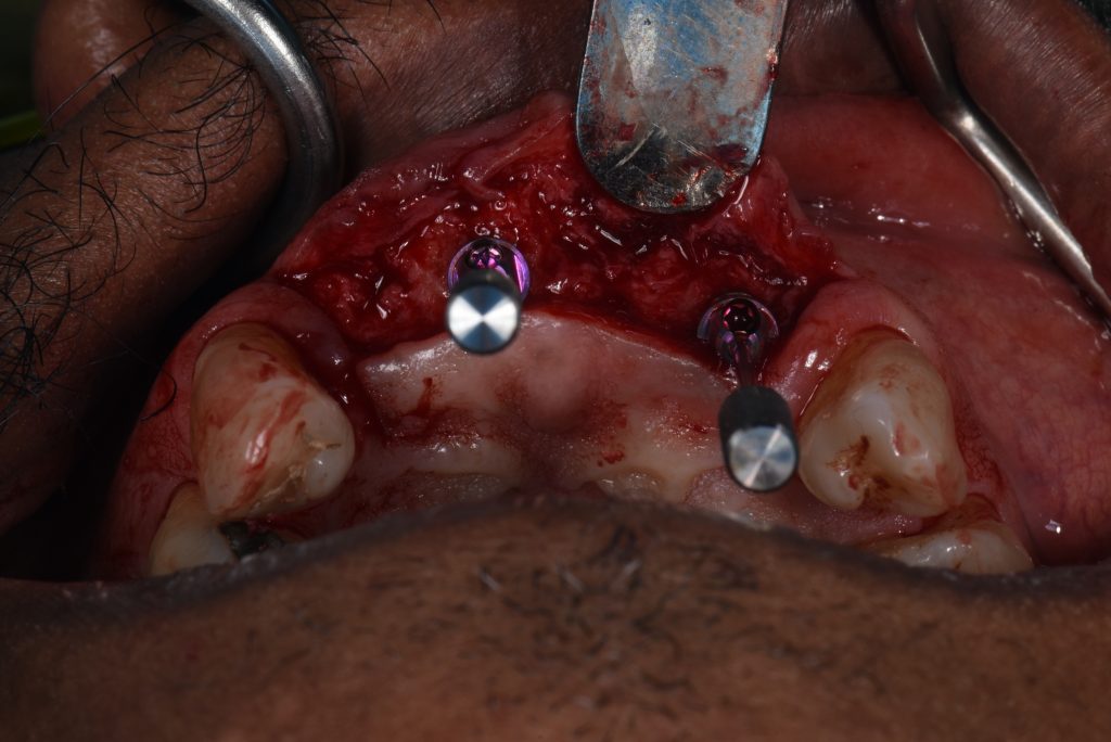 Occlusal view of the Straumann SRA multi-unit abutments