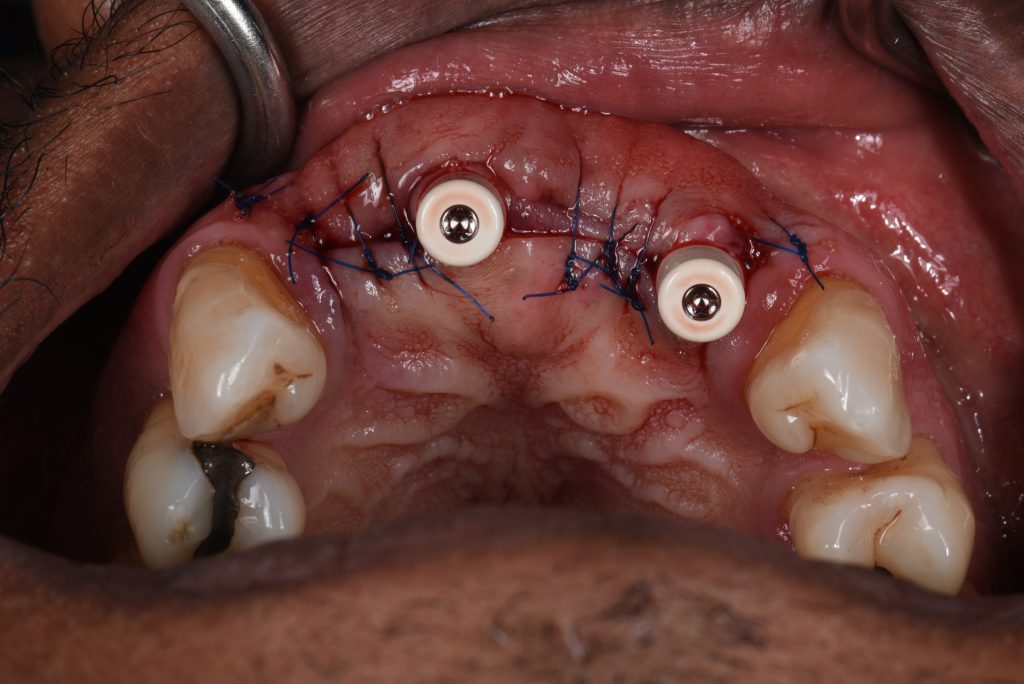 The healing abutments in situ and closure with 6-0 monofilament sutures