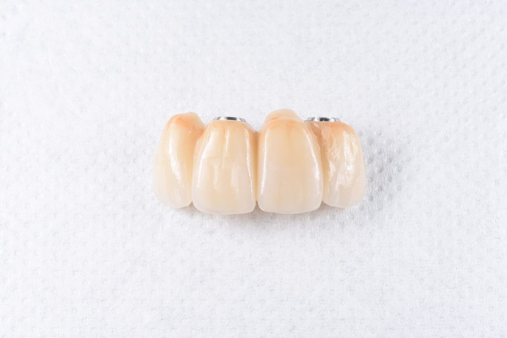 The definitive zirconia prosthesis with minimal buccal layering
