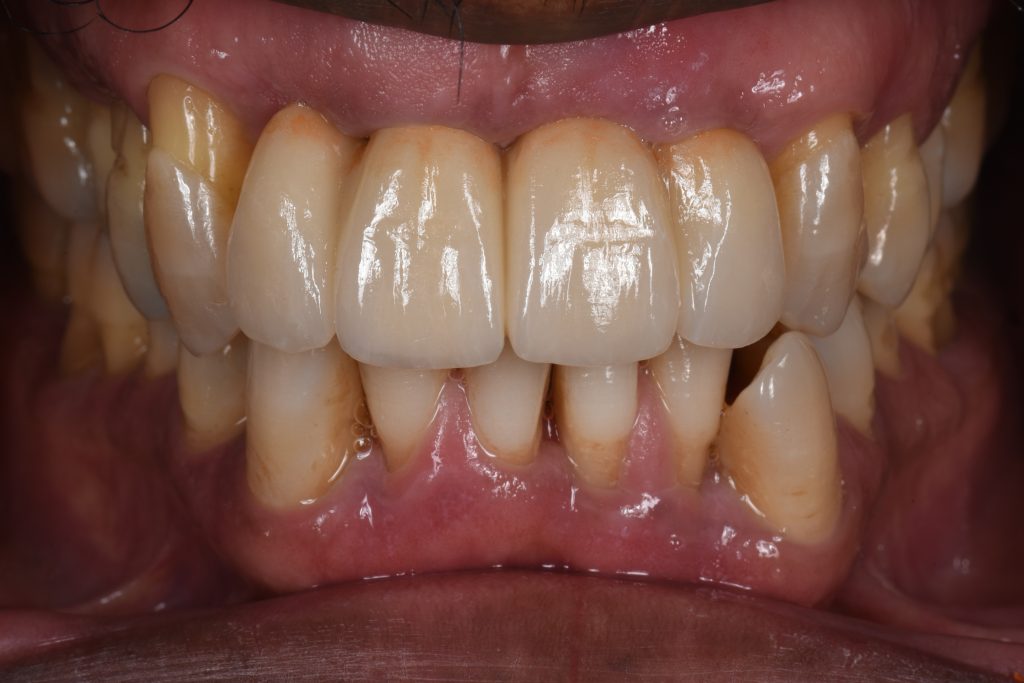 Post-operative intraoral photograph