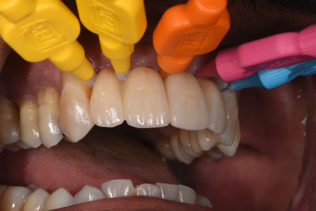 Demonstration of interdental space facilitating cleaning