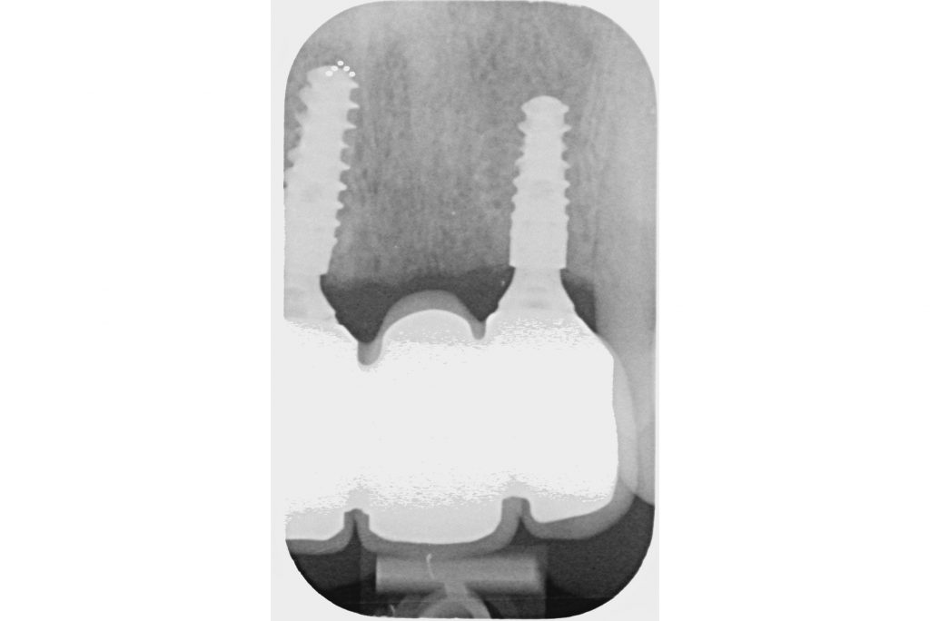 Post-operative radiograph showing the good fit of the prosthesis and good bone levels around the implants