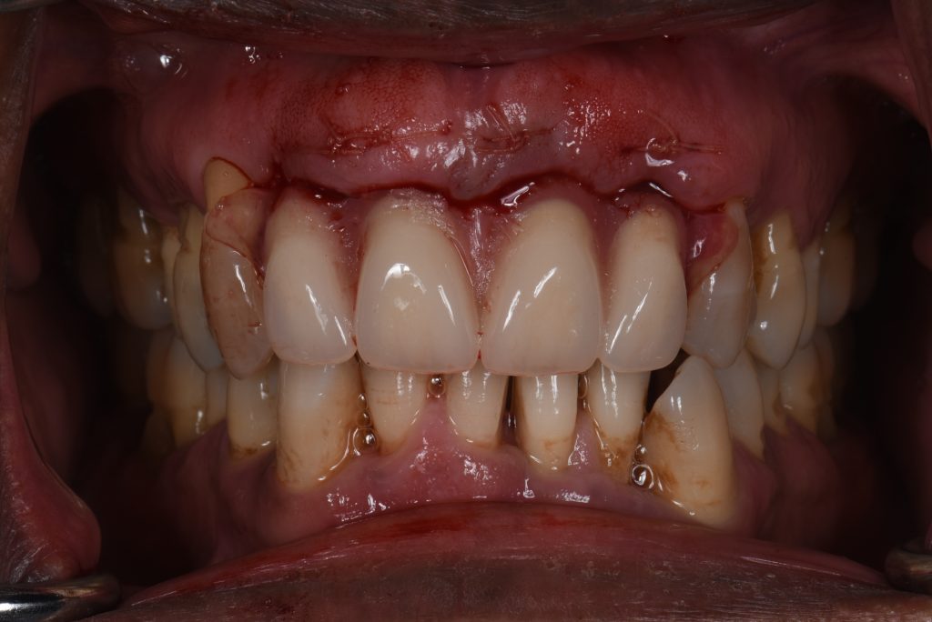 The immediate acrylic denture on the day of the extractions