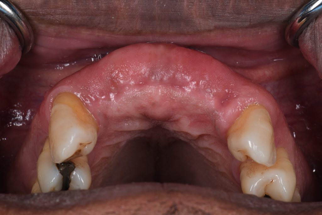 Occlusal view of the partially healed extraction sites