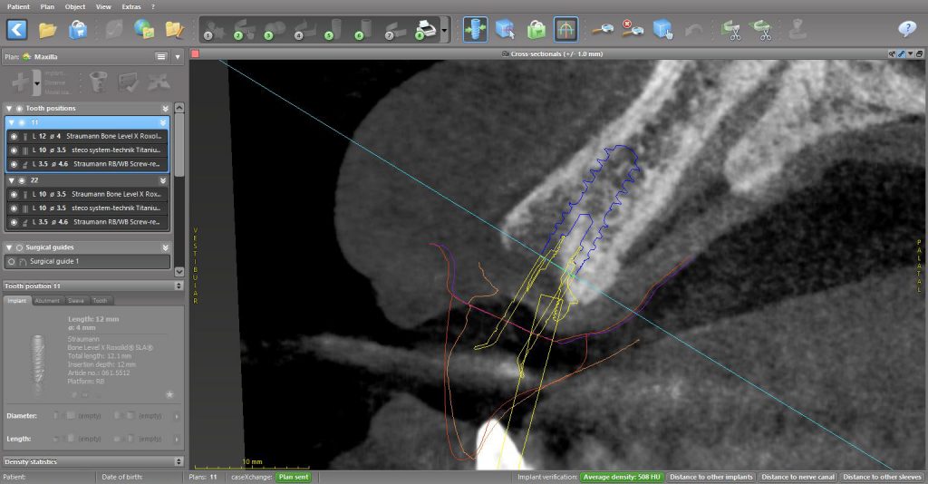 Screenshot of the implant planning. Note the proclined maxilla and planned abutment – 17-degree SRA