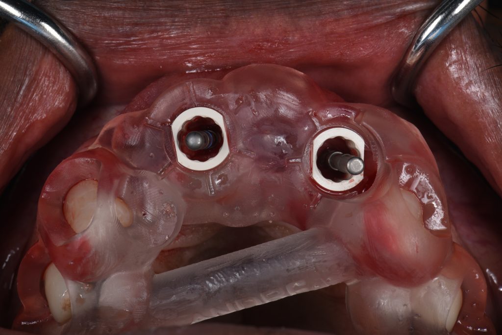 Occlusal view of the surgical guide during the osteotomies