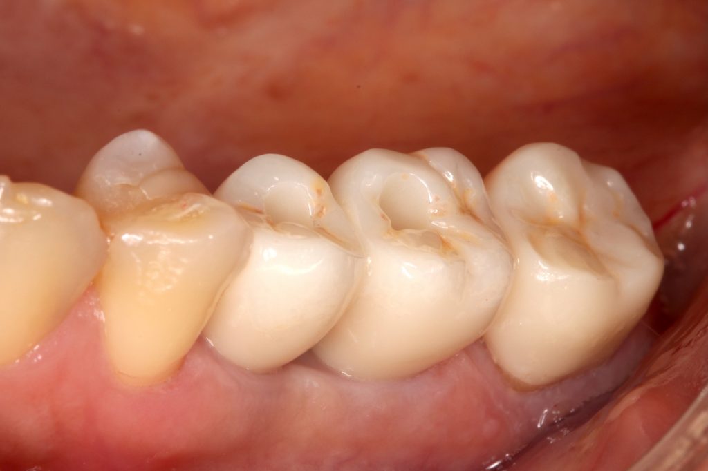 Close-up view of intraoral fitting of CAD/CAM implant restoration